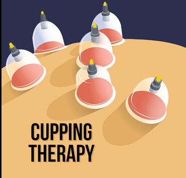 Hijama Cupping Therapy